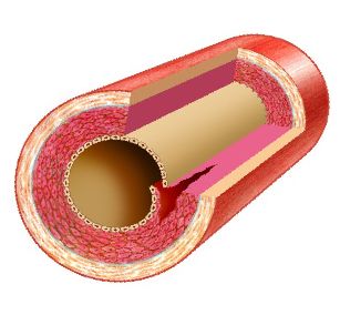 造影导丝是什么珍藏 冠脉造影从流程到诊断，基础必备！_https://www.jmylbn.com_新闻资讯_第93张