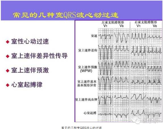 ​致命心电图，值班请牢记！