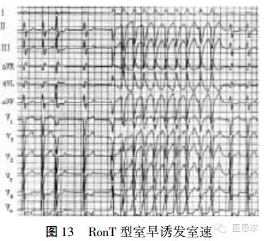 ​致命心电图，值班请牢记！