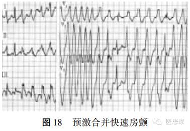​致命心电图，值班请牢记！