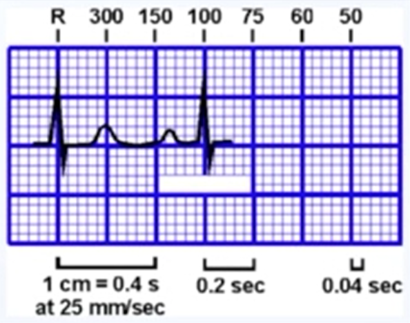 什么是同步心电图心电图学不会、记不住？这个合集very good！_https://www.jmylbn.com_新闻资讯_第4张