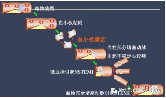 急性心梗的识别与处理！一文总结！