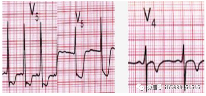 急性心梗的识别与处理！一文总结！