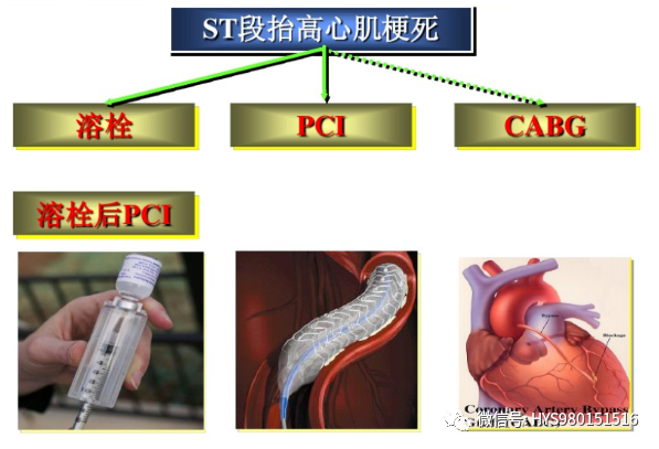 急性心梗的识别与处理！一文总结！