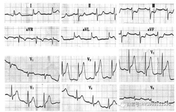 急性心梗的识别与处理！一文总结！