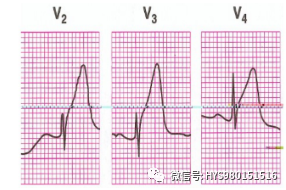 急性心梗的识别与处理！一文总结！