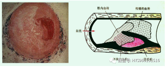急性心梗的识别与处理！一文总结！