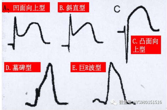 急性心梗的识别与处理！一文总结！