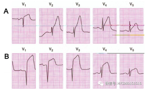 急性心梗的识别与处理！一文总结！