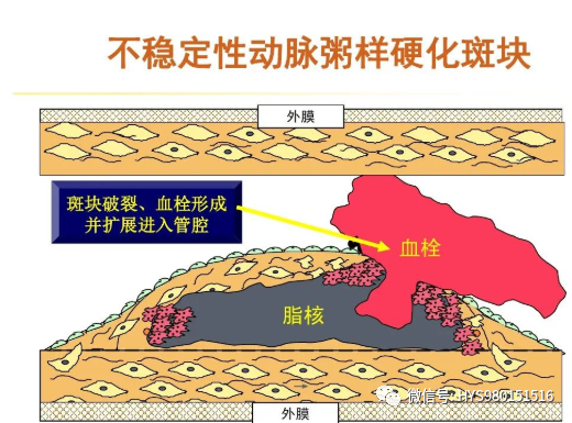 急性心梗的识别与处理！一文总结！
