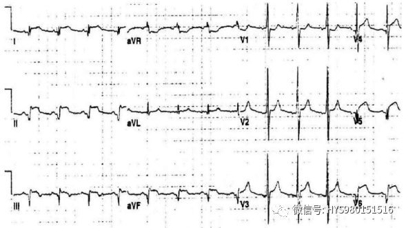 急性心梗的识别与处理！一文总结！