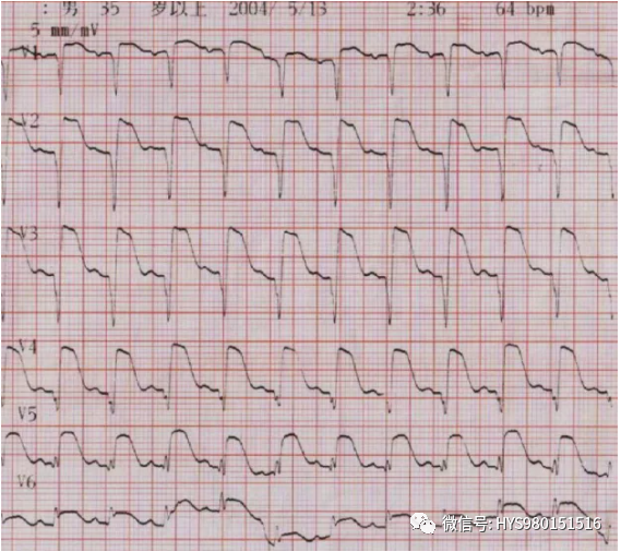 急性心梗的识别与处理！一文总结！