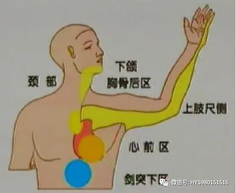 急性心梗的识别与处理！一文总结！