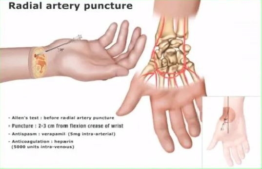 桡动脉穿刺技巧，你要知道的细节都在这！