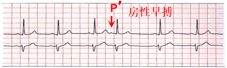 心电图自动分析有哪些心电图识分析六步走_https://www.jmylbn.com_新闻资讯_第18张