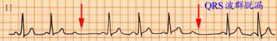 心电图自动分析有哪些心电图识分析六步走_https://www.jmylbn.com_新闻资讯_第34张