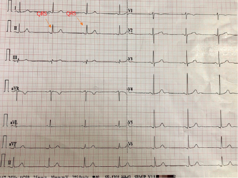 心电图自动分析有哪些心电图识分析六步走_https://www.jmylbn.com_新闻资讯_第43张