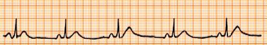 心电图自动分析有哪些心电图识分析六步走_https://www.jmylbn.com_新闻资讯_第15张