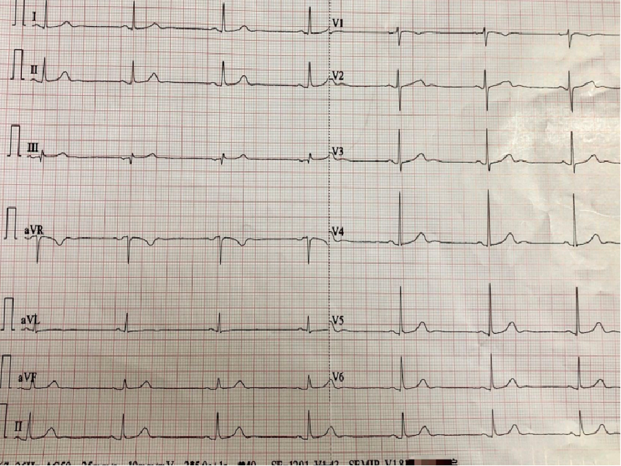 心电图自动分析有哪些心电图识分析六步走_https://www.jmylbn.com_新闻资讯_第45张