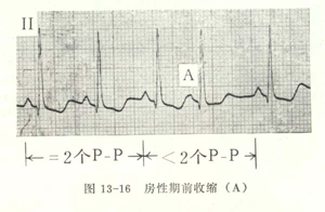 心电图自动分析有哪些心电图识分析六步走_https://www.jmylbn.com_新闻资讯_第19张