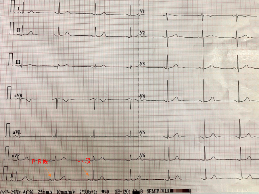心电图自动分析有哪些心电图识分析六步走_https://www.jmylbn.com_新闻资讯_第42张