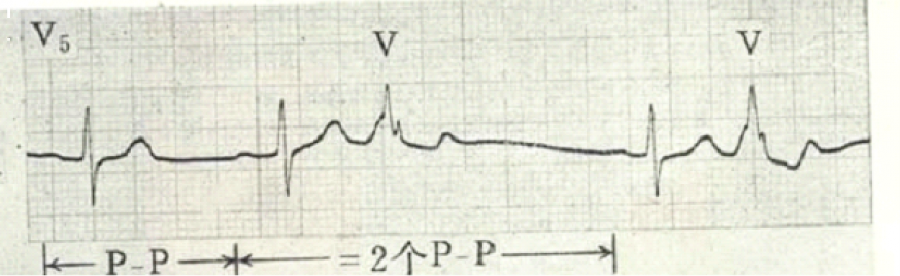 心电图自动分析有哪些心电图识分析六步走_https://www.jmylbn.com_新闻资讯_第21张