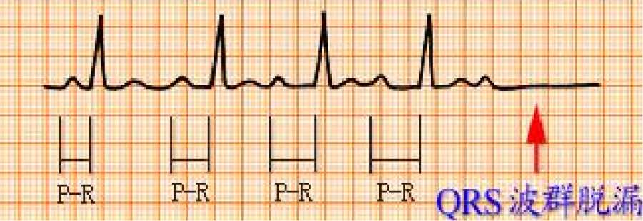 心电图自动分析有哪些心电图识分析六步走_https://www.jmylbn.com_新闻资讯_第33张