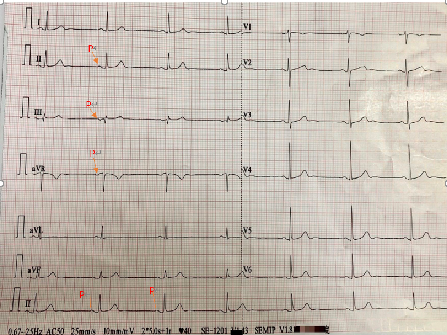 心电图自动分析有哪些心电图识分析六步走_https://www.jmylbn.com_新闻资讯_第41张