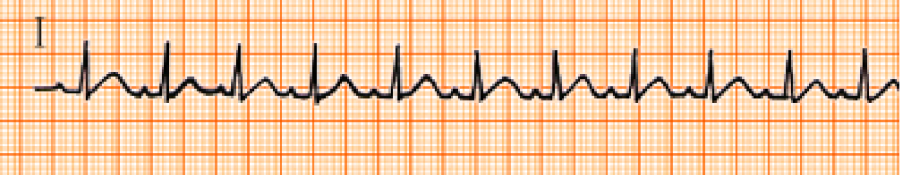 心电图自动分析有哪些心电图识分析六步走_https://www.jmylbn.com_新闻资讯_第14张