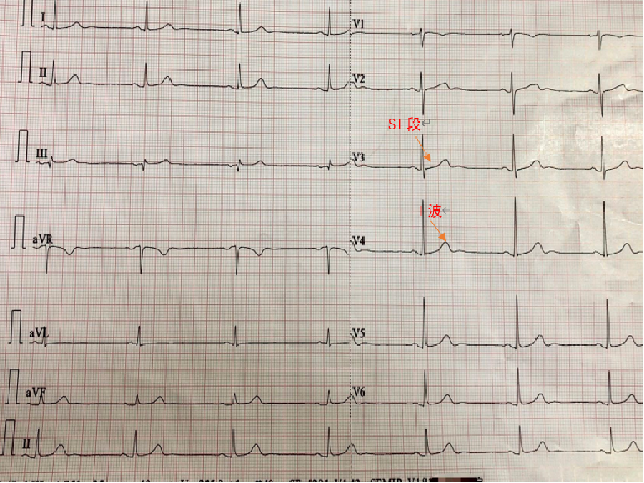 心电图自动分析有哪些心电图识分析六步走_https://www.jmylbn.com_新闻资讯_第44张