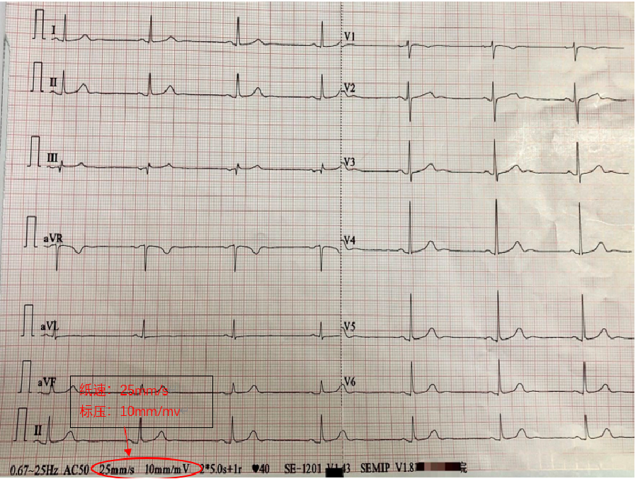 心电图自动分析有哪些心电图识分析六步走_https://www.jmylbn.com_新闻资讯_第40张