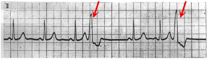 心电图自动分析有哪些心电图识分析六步走_https://www.jmylbn.com_新闻资讯_第20张