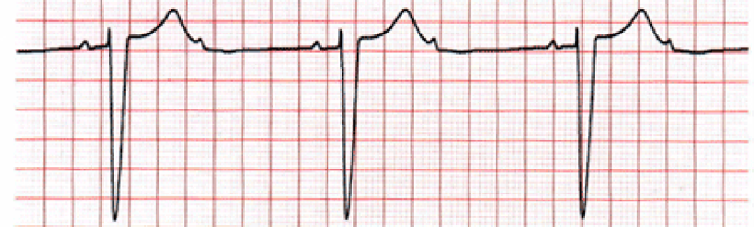 心电图自动分析有哪些心电图识分析六步走_https://www.jmylbn.com_新闻资讯_第35张