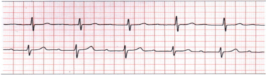 心电图自动分析有哪些心电图识分析六步走_https://www.jmylbn.com_新闻资讯_第32张