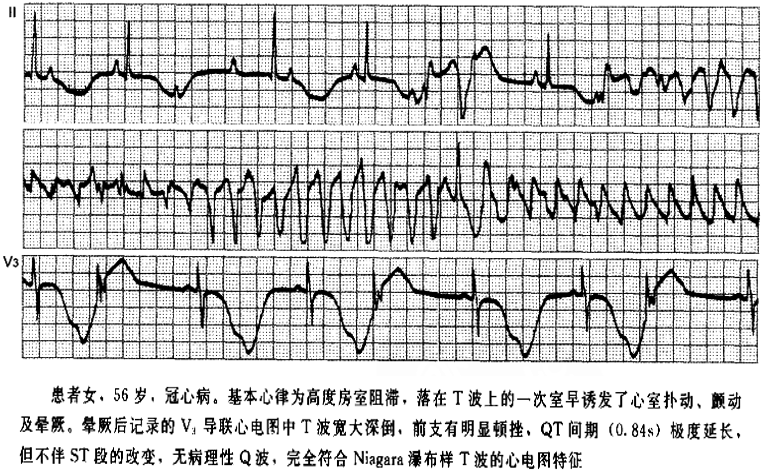 猝死預警心電圖分析經典病例