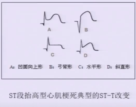 综合征合并新发束支传导阻滞巨r波形st段弓背向下抬高缺血性j波临床上