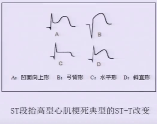 winter综合征合并新发束支传导阻滞巨r波形st段弓背向下抬高缺血性j波