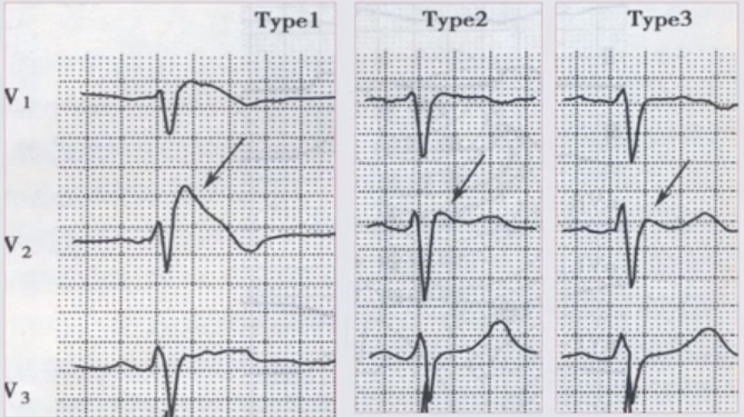 心电图brugada波样改变图片