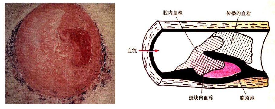 太全了！急性心梗的识别与处理，赶紧存起来