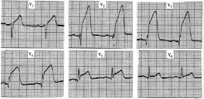 太全了！急性心梗的识别与处理，赶紧存起来