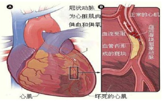 太全了！急性心梗的识别与处理，赶紧存起来