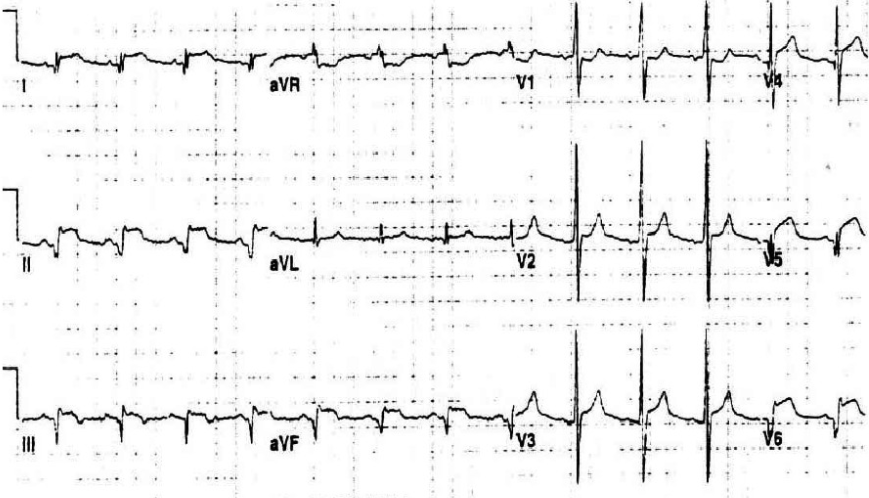 太全了！急性心梗的识别与处理，赶紧存起来
