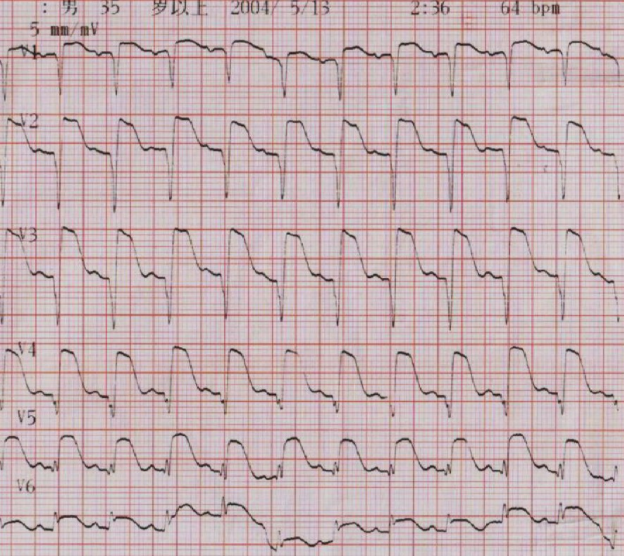 太全了！急性心梗的识别与处理，赶紧存起来
