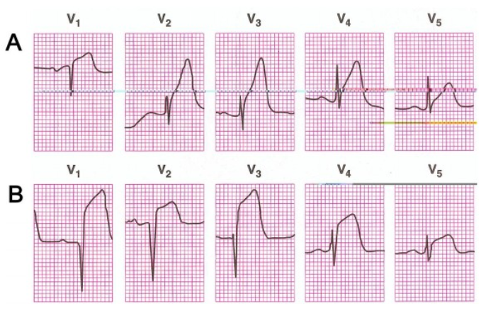 太全了！急性心梗的识别与处理，赶紧存起来