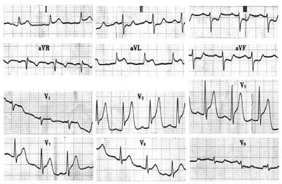 太全了！急性心梗的识别与处理，赶紧存起来