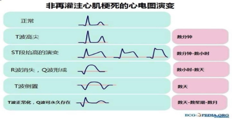 太全了！急性心梗的识别与处理，赶紧存起来