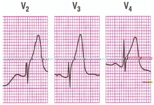 太全了！急性心梗的识别与处理，赶紧存起来