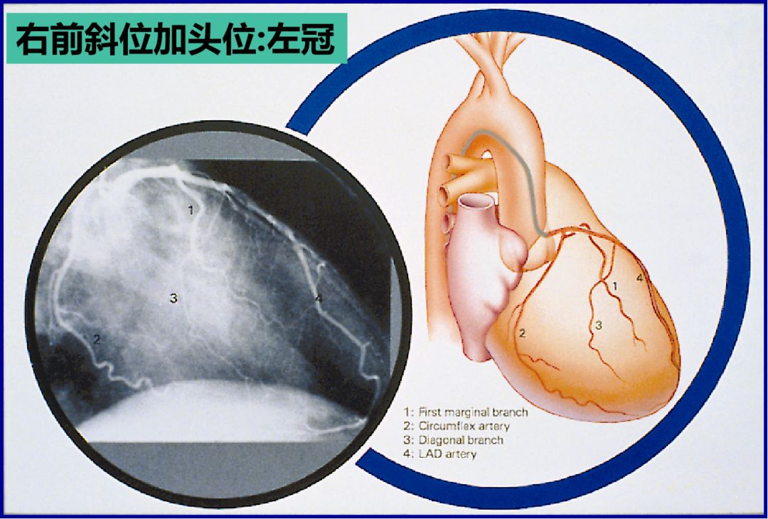 造影导丝是什么珍藏 冠脉造影从流程到诊断，基础必备！_https://www.jmylbn.com_新闻资讯_第51张
