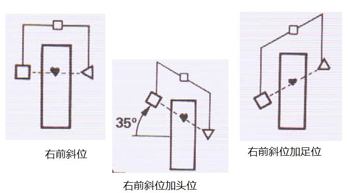 造影导丝是什么珍藏 冠脉造影从流程到诊断，基础必备！_https://www.jmylbn.com_新闻资讯_第40张