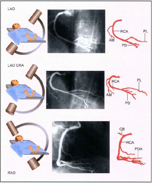 造影导丝是什么珍藏 冠脉造影从流程到诊断，基础必备！_https://www.jmylbn.com_新闻资讯_第44张